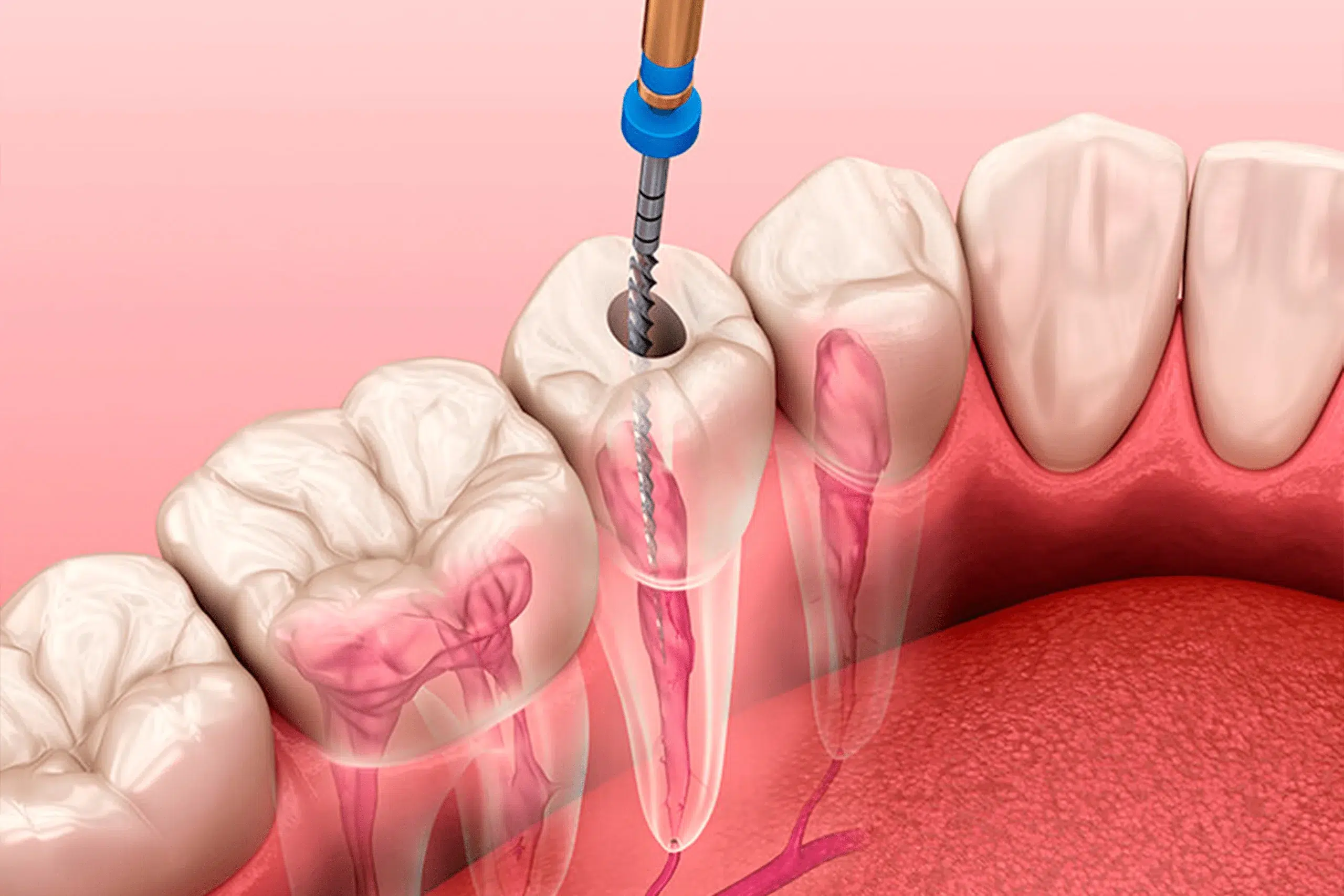 Sobre endodontia