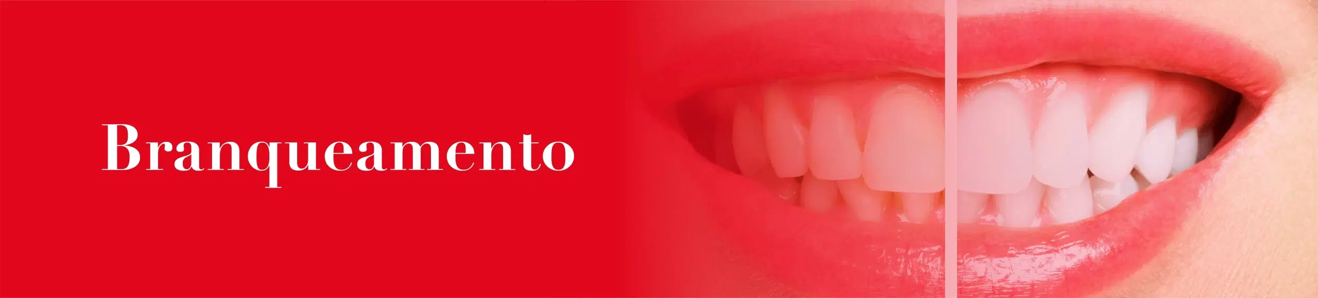 banner-branqueamento-mobile Branqueamento Dentário OralPlan