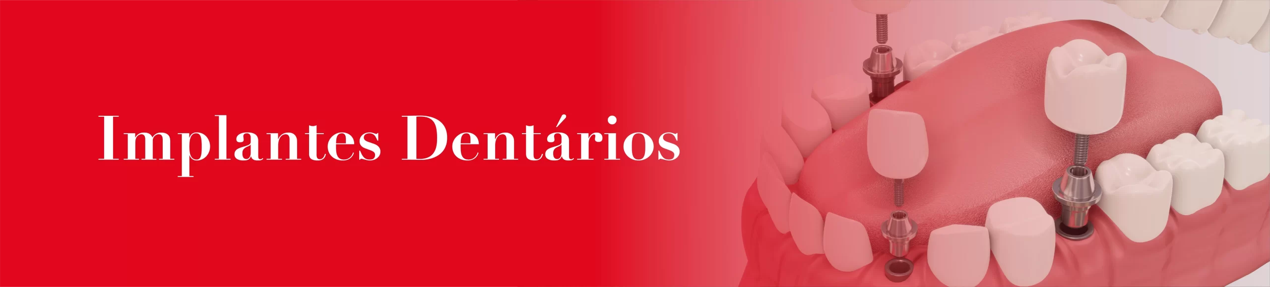banner-implantes-mobile Implantes Dentários OralPlan