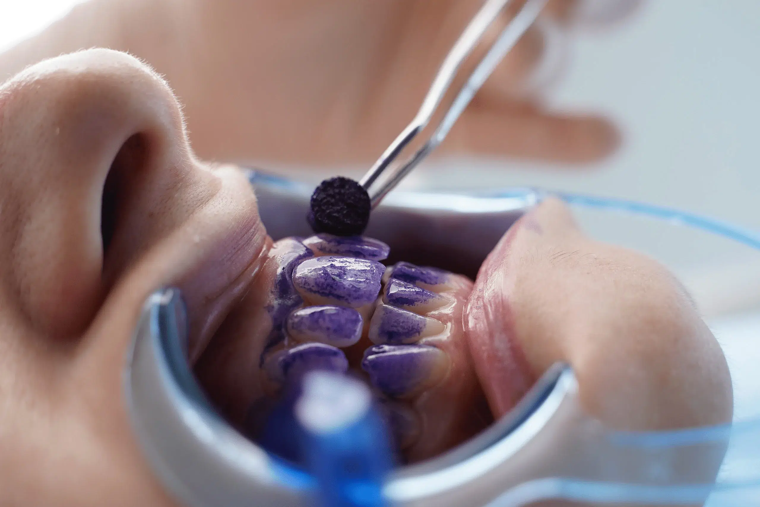 higiene-oral-branquear Processo de higiene oral - branquear