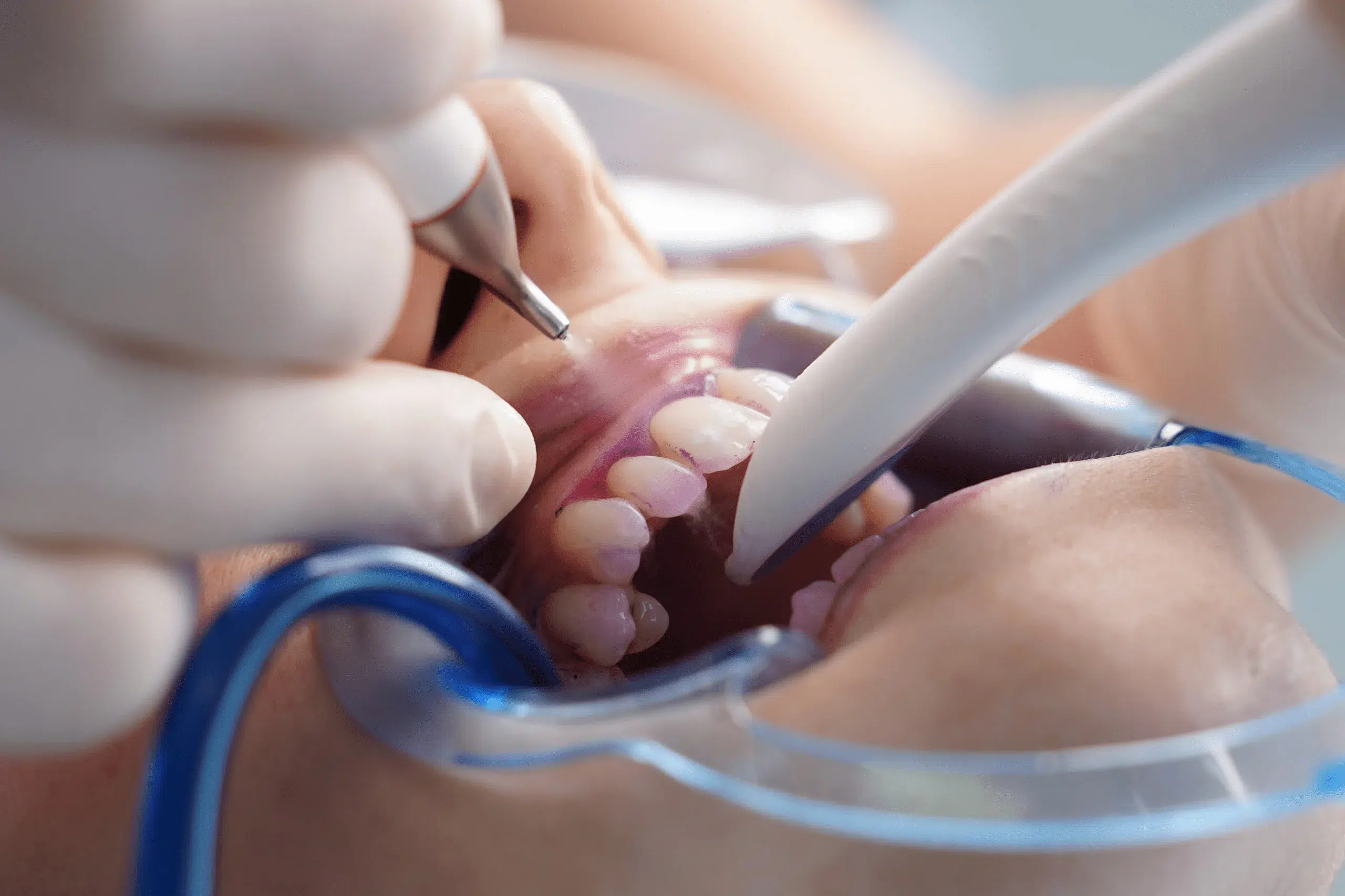 higiene-oral-limpeza Processo de higiene oral - limpeza