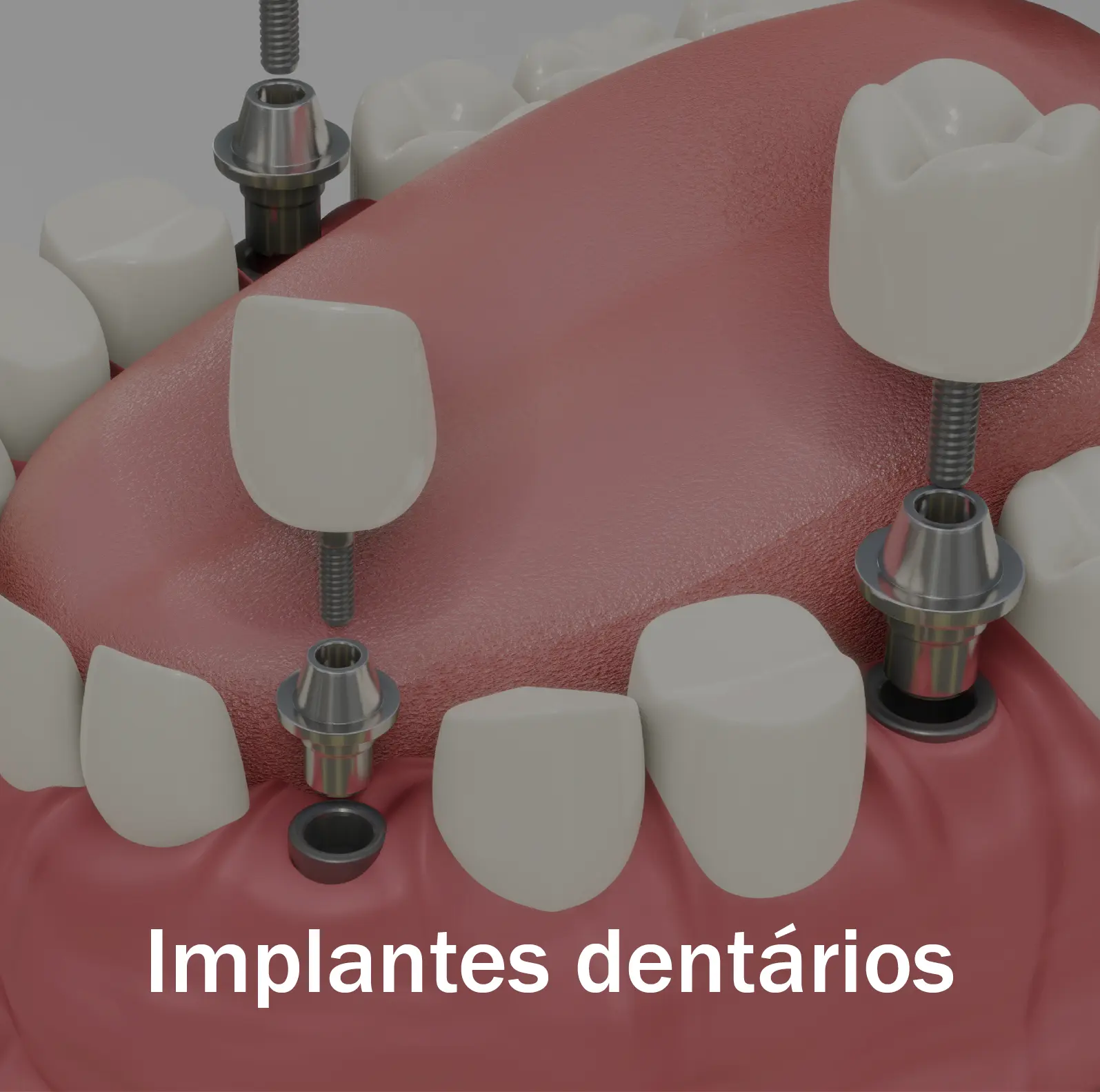 Serviço Clínica OralPlan - Implantes Dentários