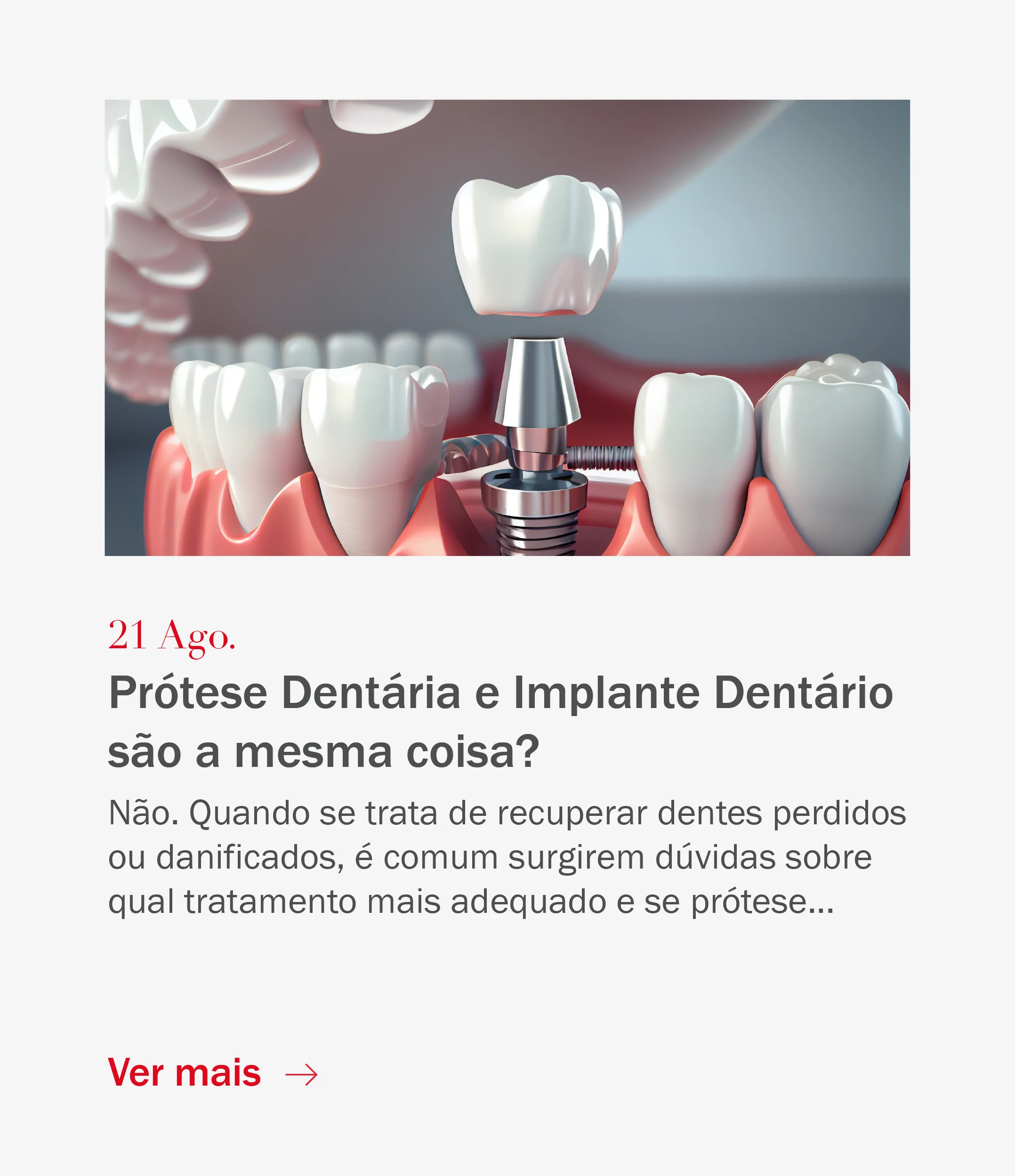Prótese Dentária e Implante dentário são a mesma coisa?