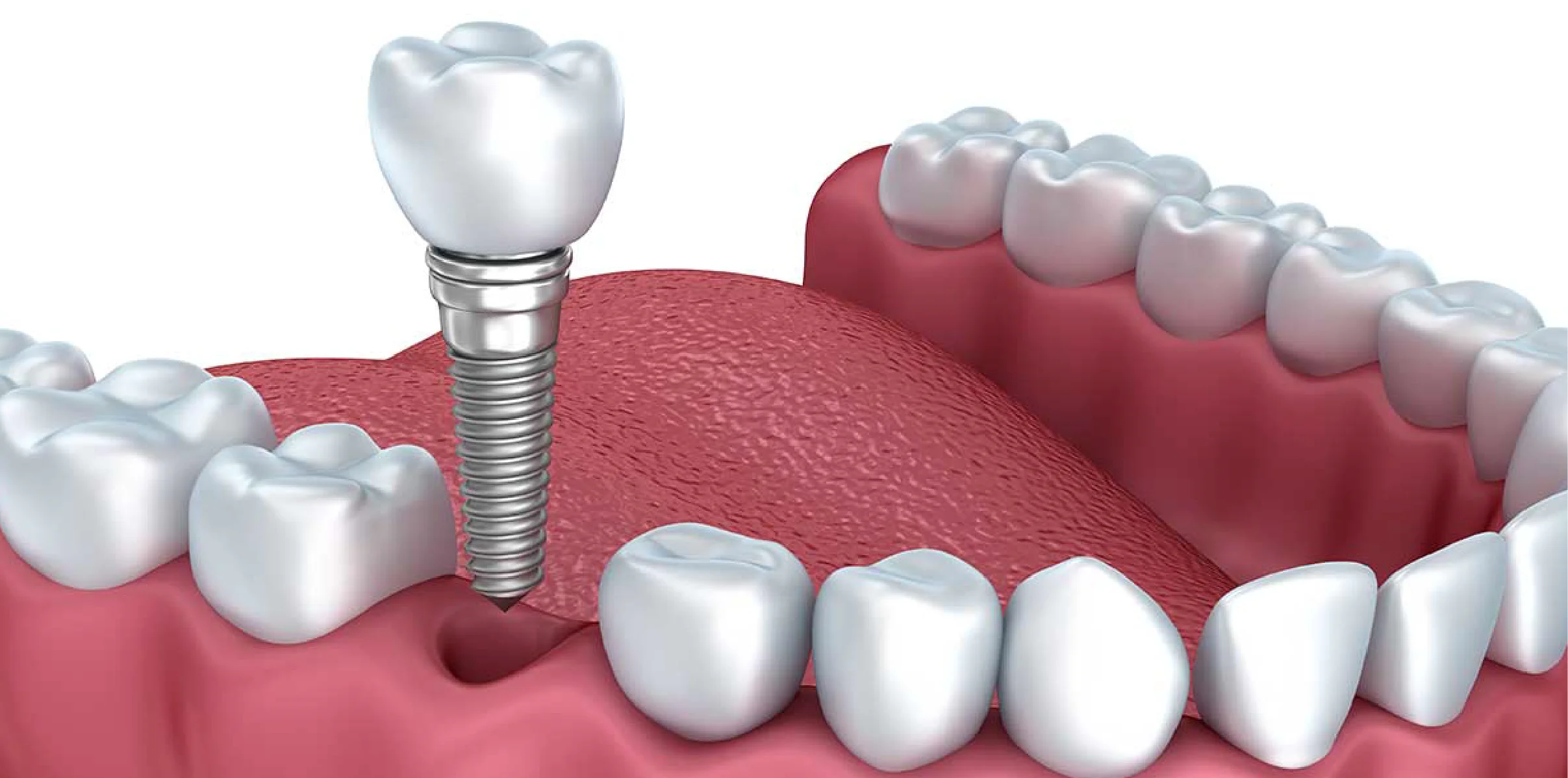 Colocação de um Implante dentário
