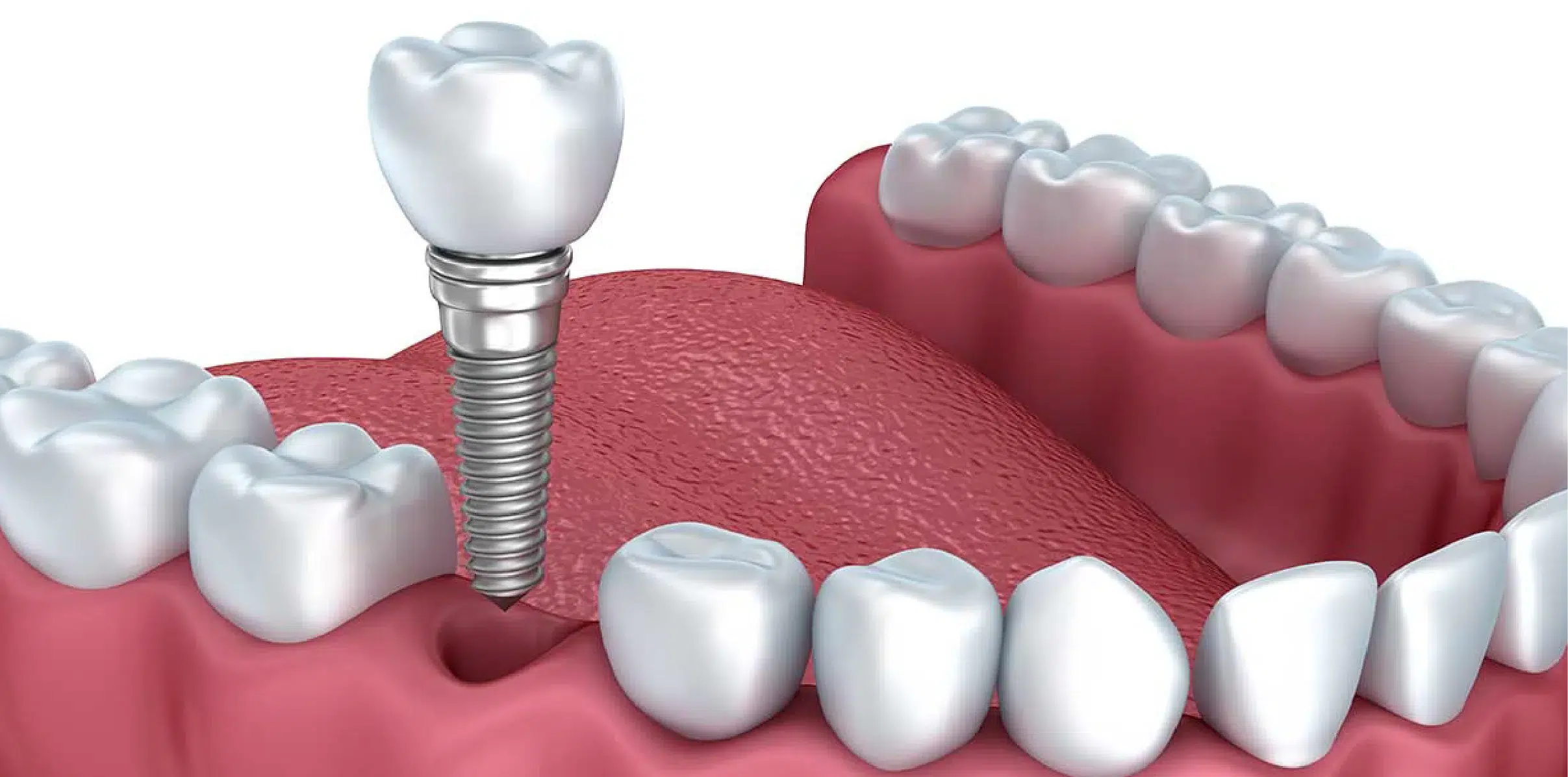 Colocação de um Implante dentário