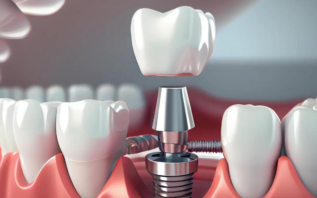 Prótese Dentária e Implante Dentário são a mesma coisa?