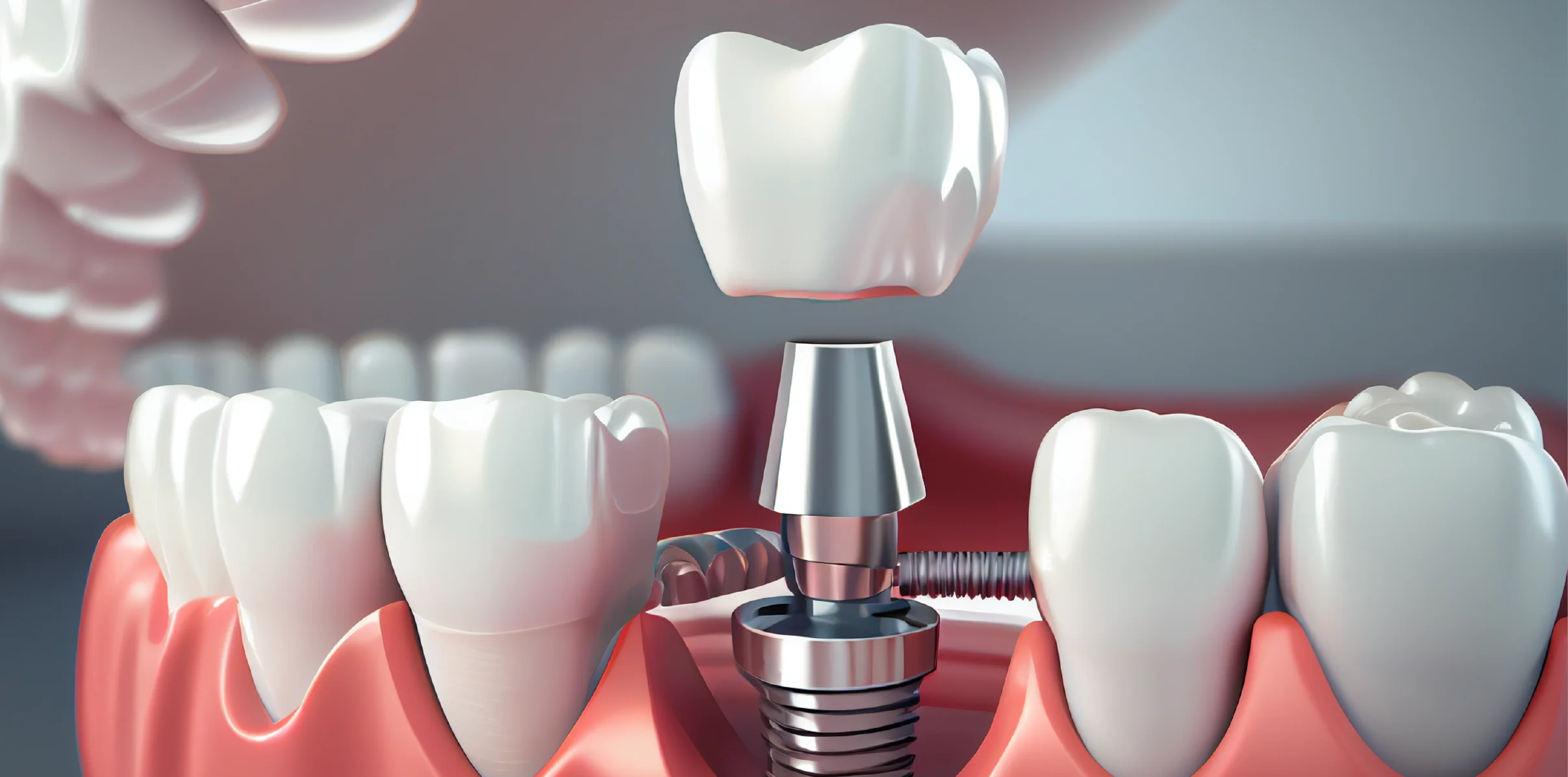 Diferença de implante dentário e prótese dentária