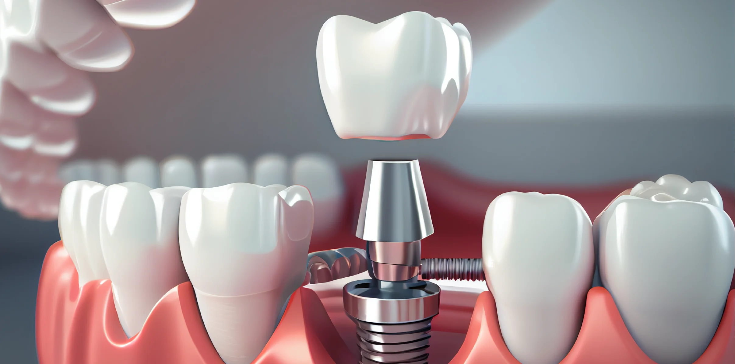 Prótese Dentária e Implante Dentário OralPlan