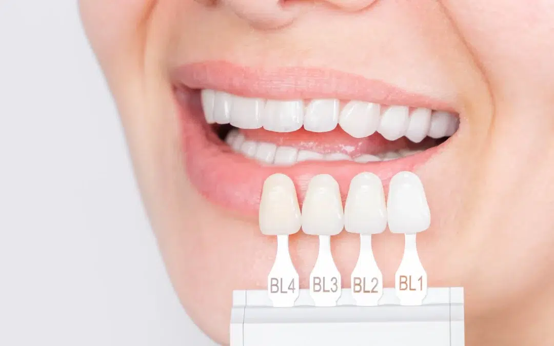 Facetas Dentárias: quais as vantagens e desvantagens?