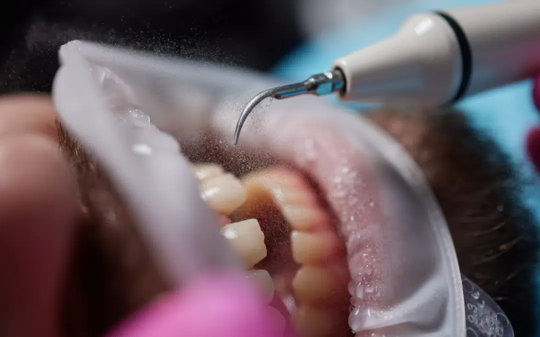 O que é o “Jato de Água” e como funciona na limpeza de Próteses Fixas?