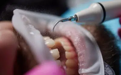 O que é o “Jato de Água” e como funciona na limpeza de Próteses Fixas?