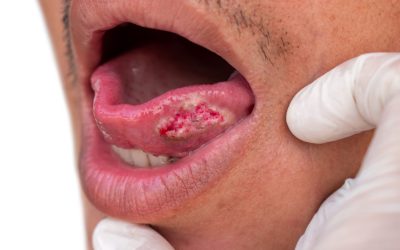 Cancro Oral