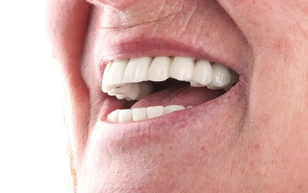 Vantagens do All-on-4® para quem já perdeu todos os dentes