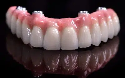 As 4 etapas do tratamento All-on-4® explicadas de forma simples