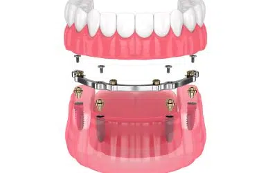 Higiene e cuidado com uma prótese fixa com barra fresada